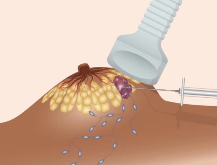 Microbiopsie mammaire écho-guidée — prélèvement ciblé d'une lésion