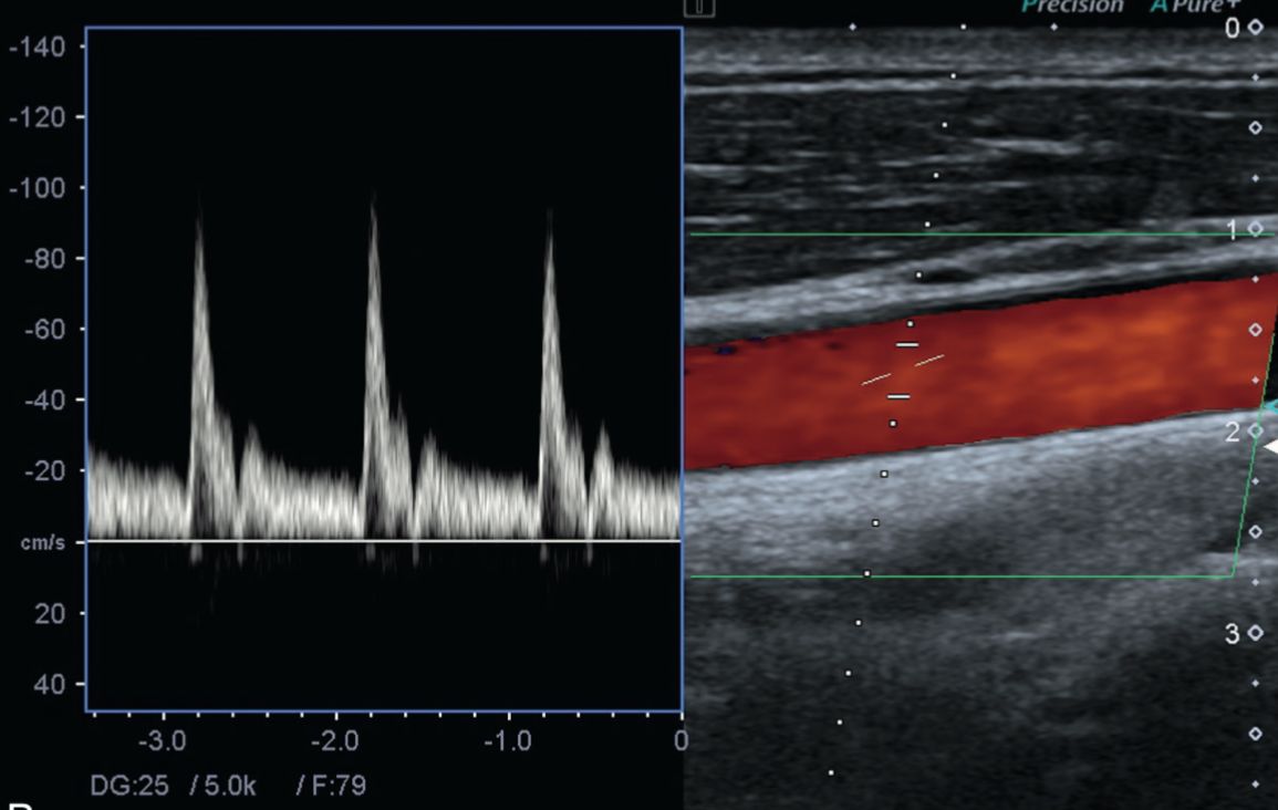 Échographie Doppler vasculaire — spectre de flux et cartographie couleur