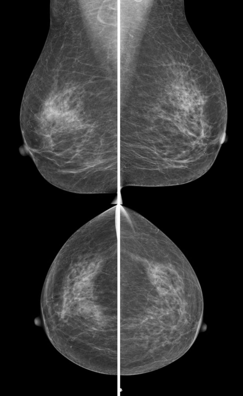 Cliché de mammographie numérique — vues des deux seins